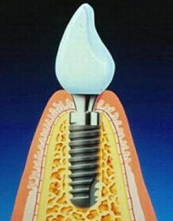 Стоматологический центр Ханерхоф - Германия - имплантация зубов