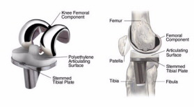 Тотальное протезирование коленного сустава