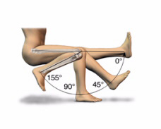 Протезирование коленного сустава